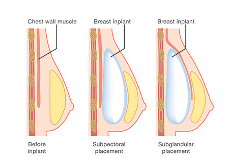 Implant Placement