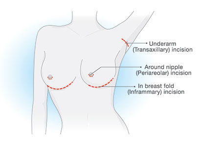 Breast Augmentation Incision