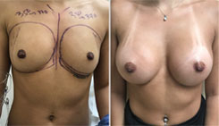 Breast Augmentation 350 cc implants