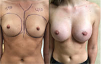 Before and After photo of Breast Augmentation