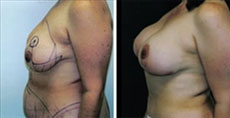 Beverly Hills Breast Lift before and after photos Beverly Hills Breast Lift before and after photos