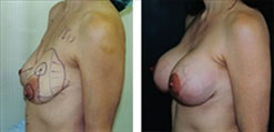 Breast Lift with 350cc implants Breast Lift with 350cc implants