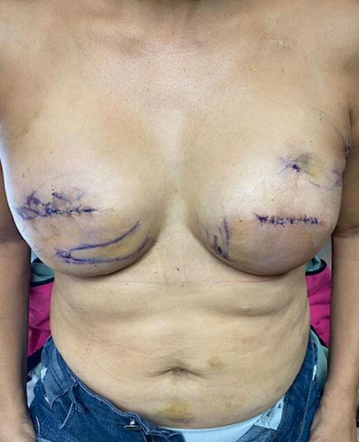 Breast revision cancer patient 1a