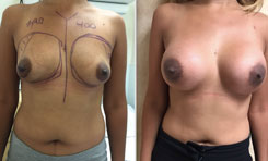 400 cc implant used for this breast revision surgery