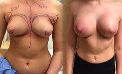 Breast revision before and after photo 400 cc