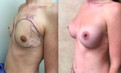 345 cc breast implant, breast revision