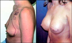 Breast revision 350 cc before and after