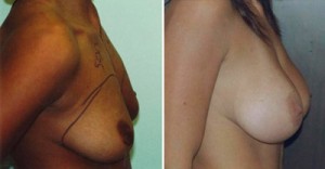 Woman before and after photo of silicone breast augmentation