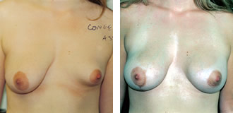 Before: Right 34C Left 34A After: Right Mastopexy Left 390cc