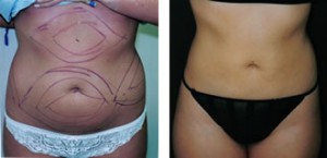 Before & After Patient