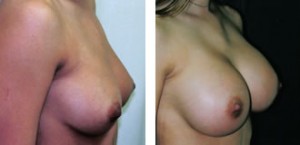 breast_aug12