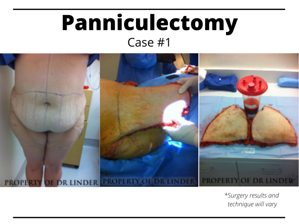 Before images and surgical images of a panniculectomy procedure performed in Beverly Hills, CA