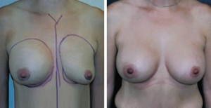 breast_asymmetry17a