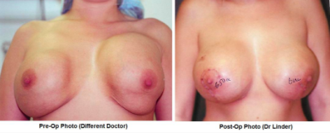 Double Bubble Deformity Before and After Photos