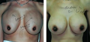 Double Bubble Breast Deformity