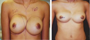 SYMMASTIA BREAST REVISION REPAIR