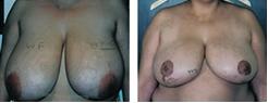 Breast Reduction Before and After Photo
