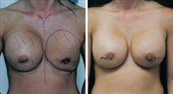 Ruptured Implant Photo  After Breast Revision