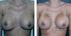 Before and after image showing treatment for capsular contracture performed in Beverly Hills. 