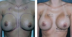 Before and after image showing treatment for capsular contracture performed in Beverly Hills.