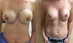 Before and after image showing a capsulectomy performed in Beverly Hills, CA.