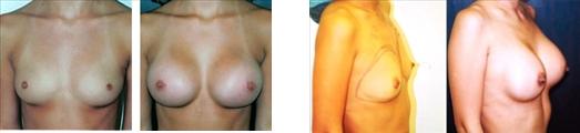  Silcone Gel Implants Before and After