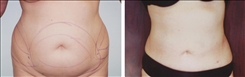 liposuction linder patient before and after