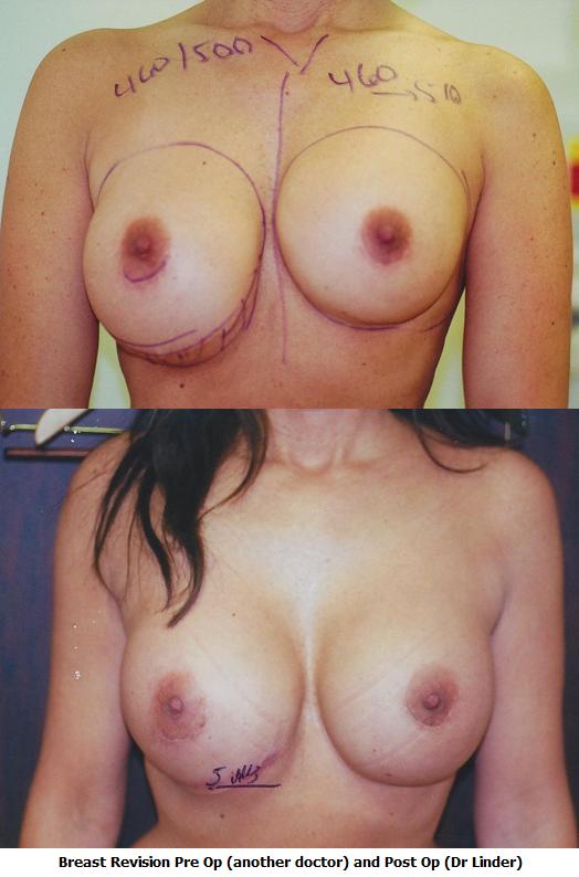 Breast Revision Photos