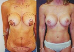 Breast Revision and Tummy Tuck pre-op and post-op photos