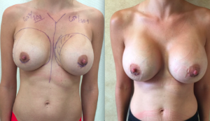 Woman Before and After Second Augmentation