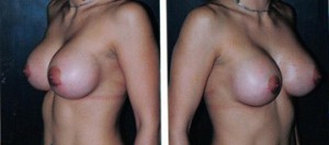 breast augmentation