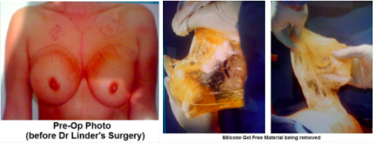 Ruptured Silicone Gel Implant 