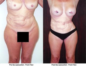 linder liposuction cobalt Covering