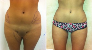 Tumescent Liposuction Technique Before and After Photos