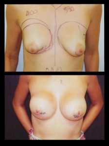 Breast Asymmetry and Tubular Deformity Before and After Photos