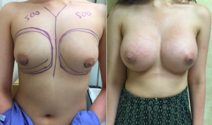 Mild Tubular Breast Deformity Before and After Photos