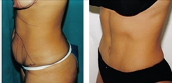 Patient before and after tummy tuck in Beverly Hills.