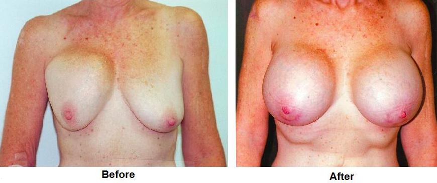 Double Bubble and Capsular Contracture Before and After Photos 