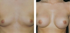 Creating a Slight Breast Enhancement