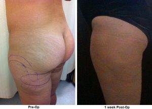Before and After Liposuction 