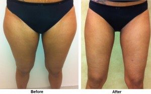 Woman Having Undergone Liposuction in Her Thighs