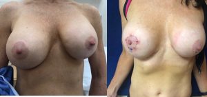 înainte și după imaginea de revizuire a sânului