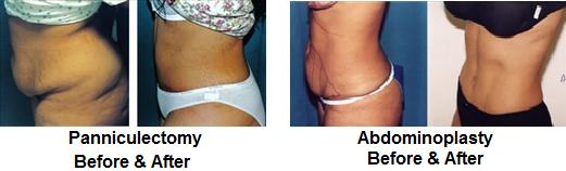 Panniculectomy Vs. Abdominoplasty (Tummy Tuck): Understanding the  Difference