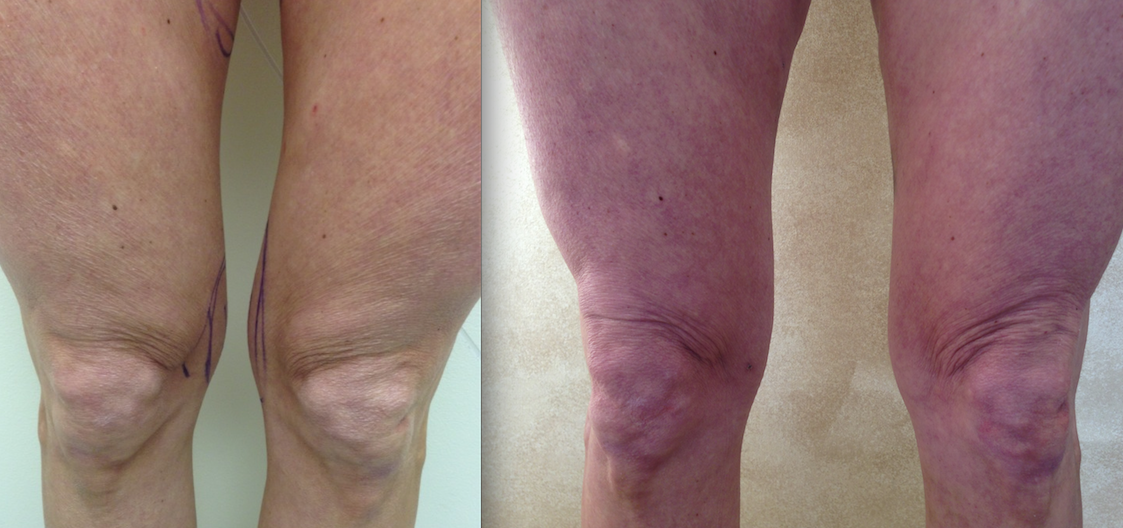 Knob Knee Lipo Before and After Results