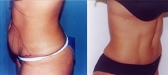 Tummy Tuck Before and After Photos