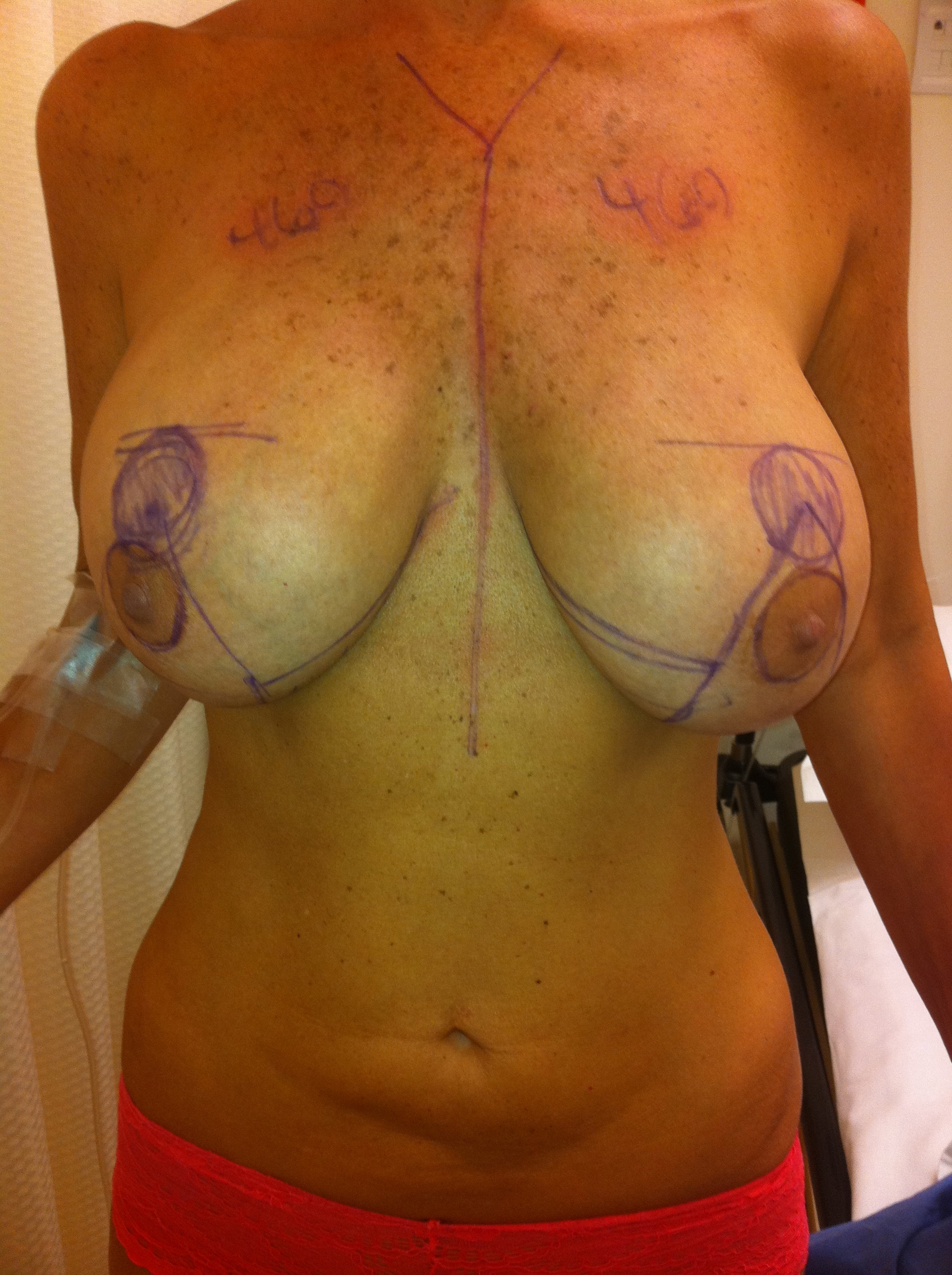 Breast cyst vs breast lump