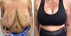 Breast Reduction Before and After: The Procedure, Insurance Coverage, and  Recovery