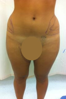 PEAR SHAPE GYNOID APPEARANCE