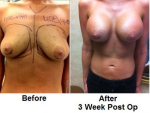 High Profile Implants, Reshaping the Breasts