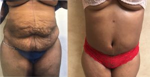 Before and After Photos of Panniculectomy